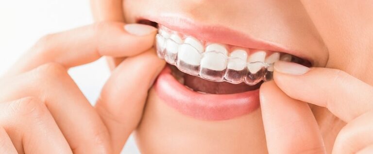 Clear Aligners