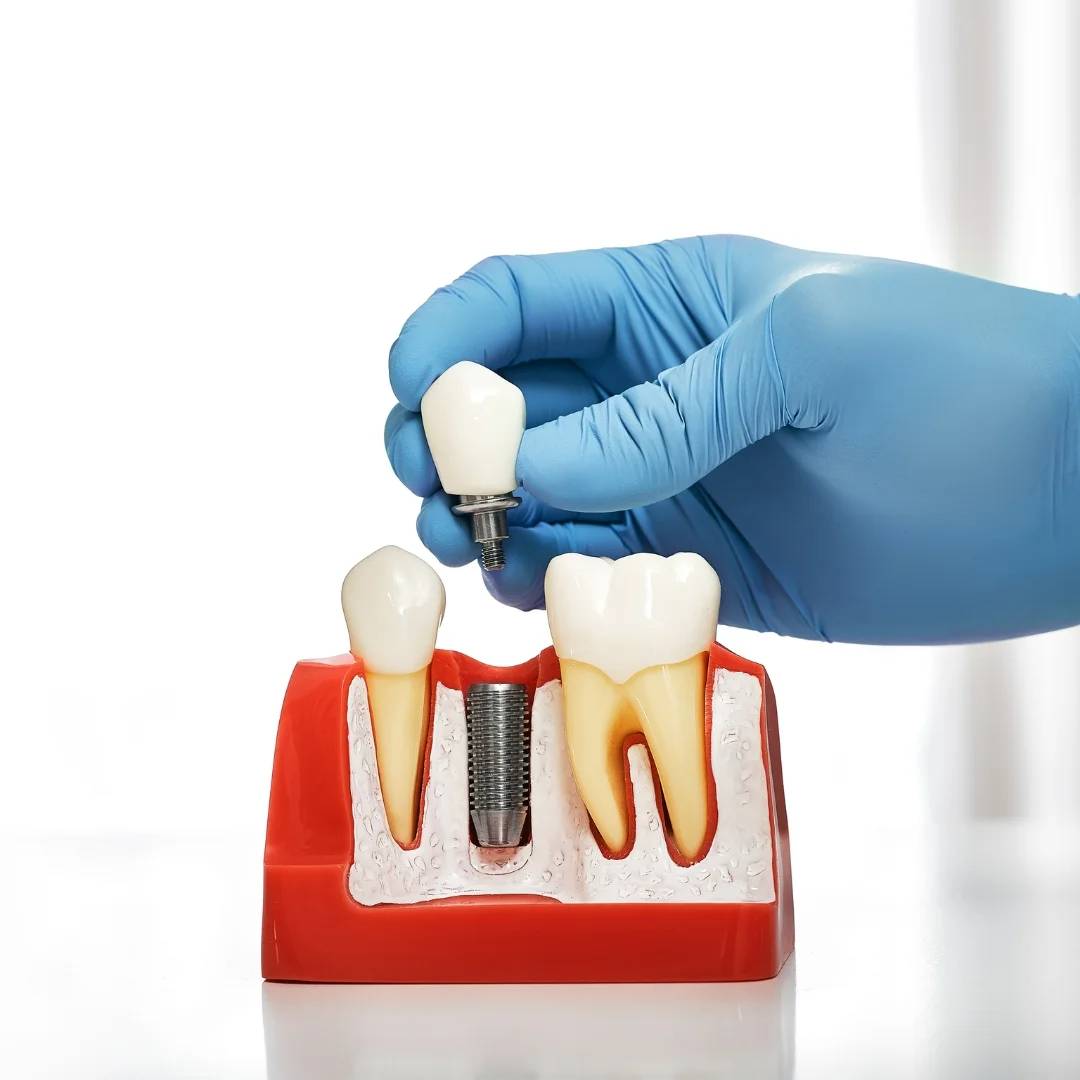 Implant Dentistry in Chatham, ON